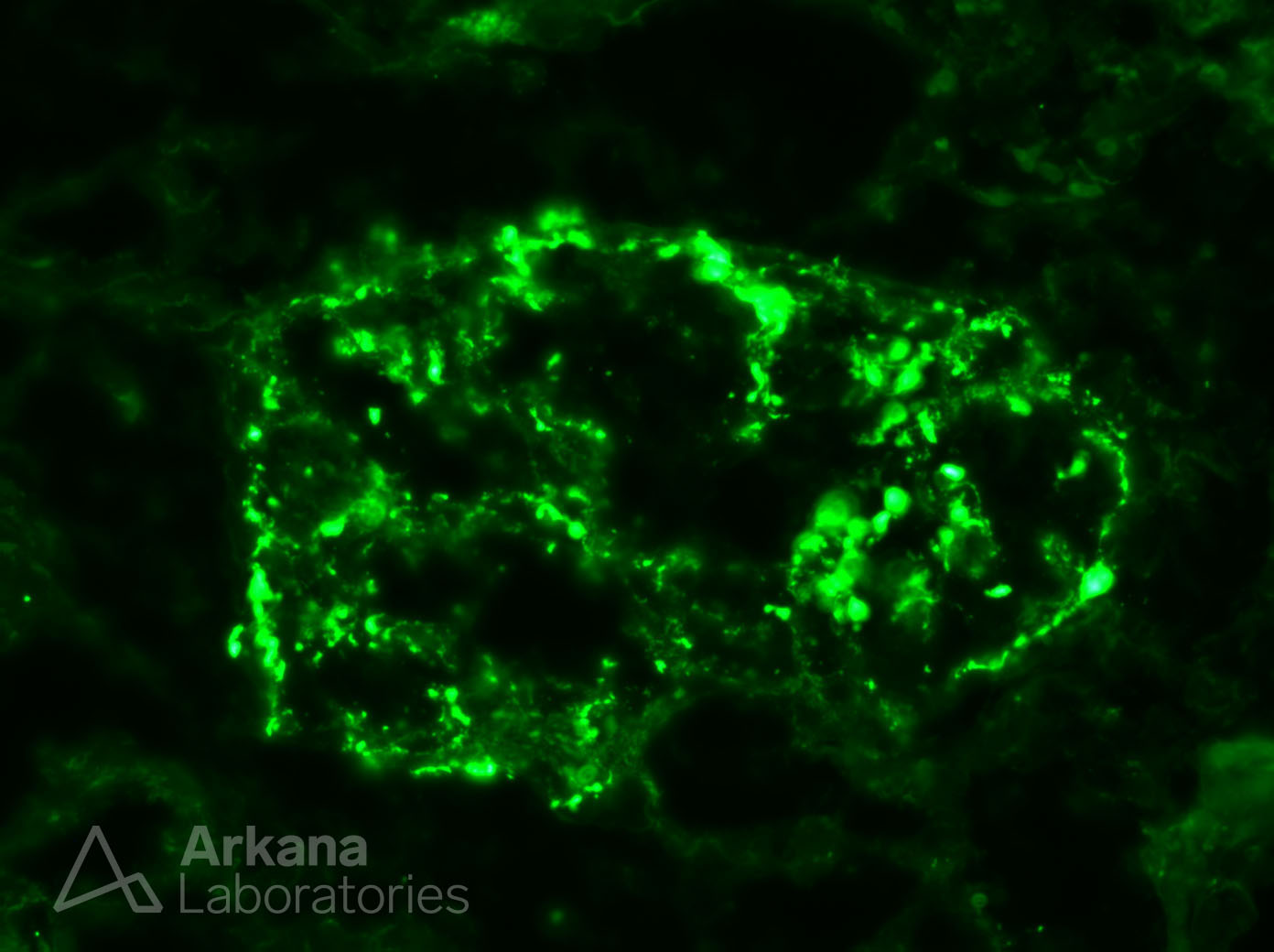 Granular, Glomerular IgG Deposits